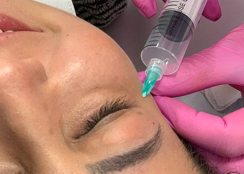 aplicação de ozonioterapia na área dos olhos de paciente mulher