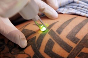 Remoção de Tatuagem a Laser